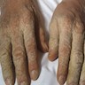 Crusted scabies clinical