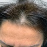 Irregular shaped patch of hair loss in frontal region