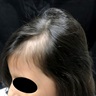 Bizarre shaped alopecia patch in frontotemporal region
