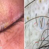 Eyelashes and scalp: black dots, broken hairs, V-sign
