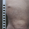 Subcutaneous nodule of right thigh