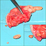 Subcutaneous encapsulated fat necrosis