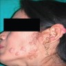 Multiple facial papules
