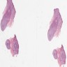 Circumscribed dermal tumor of fascicles of Schwann cells and axons