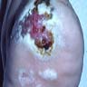 Erosive and macerated lesion