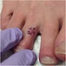 Right dorsal third toe