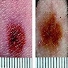 Minimal change in a clinically dysplastic nevus