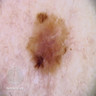 Dermoscopy of melanoma in adolescent