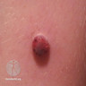 Spitzoid melanoma in child
