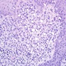 Signet ring cell melanoma