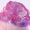 Small cell melanoma