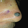 Blue-black, dome shaped nodule on nose