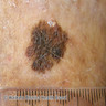 Superficial spreading melanoma