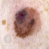 Dermoscopy of superficial spreading melanoma