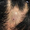 Pigmented nodule on scalp
