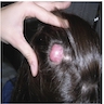 Scalp lesion with alopecia