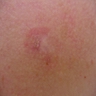 Erythematous patch on chest