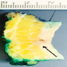 Lesion between dermis and hypodermis