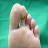 Left great toe