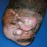 Pink nodules and plaques