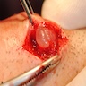Capsule in subepidermis