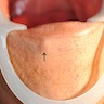 Lesion below lower lip