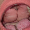 Bilateral lesion in hard palate