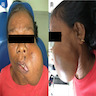 Collagenous fibroma of face