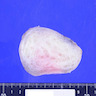 Macroscopic appearance of tumor