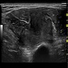 Ultrasound showing lobulated, well defined mass