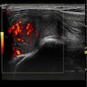 Ultrasound showing diffuse vascularity