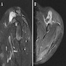 MRI showing mass with well defined margin