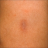 Ill defined bluish firm plaque on the left flank