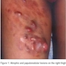 Papulonodular thigh lesions