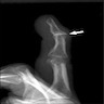 Swelling and osteophytes on Xray