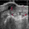 cyst and flow on ultrasound