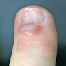 Finger with nail cleft