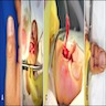 Intraoperative view of cyst