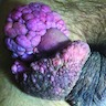 Penile fibroepithelial polyp
