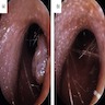 Fibroepithelial polyp<br>at posterior wall of<br>external auditory canal