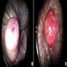 Hidradenoma papilliferum of anus