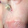 Pedunculated nodule in the upper cutaneous lip