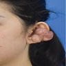 Recurrent keloid formation on earlobe
