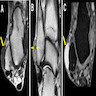 MRI findings of angioleiomyoma