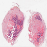 Circumscribed islands of ghost and basaloid cells