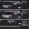 Ultrasound