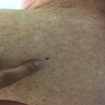 Dysplastic nevus with associated TIF