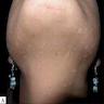 Hypopigmented macular / papular lesions