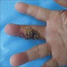 Finger tumors