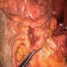 Acute duodenal ulceration
